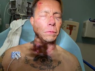 Image of Anthony Paredes with visible injuries to the face and neck, lying in a hospital setting.
