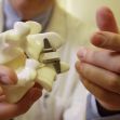 A medical professional holding a model of a spinal vertebra with an interlaminar stabilization device, illustrating the Coflex device used for treating lumbar spinal stenosis. A medical professional holding a model of a spinal vertebra with an interlaminar stabilization device, illustrating the Coflex device used for treating lumbar spinal stenosis.