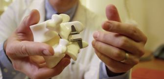 A medical professional holding a model of a spinal vertebra with an interlaminar stabilization device, illustrating the Coflex device used for treating lumbar spinal stenosis.