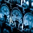 Close-up of brain scan images displayed in a medical setting. Close-up of brain scan images displayed in a medical setting.