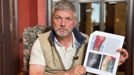 Rick Stimac holding knee scans and post op pictures